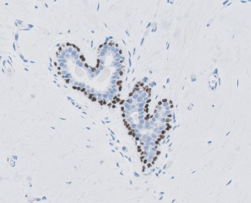 immunologie-2 image Immunopathologie Foto 2 : P63 kernkleuring, myo-epitheliale cellen in klierbuizen van mamma(borst)weefsel.