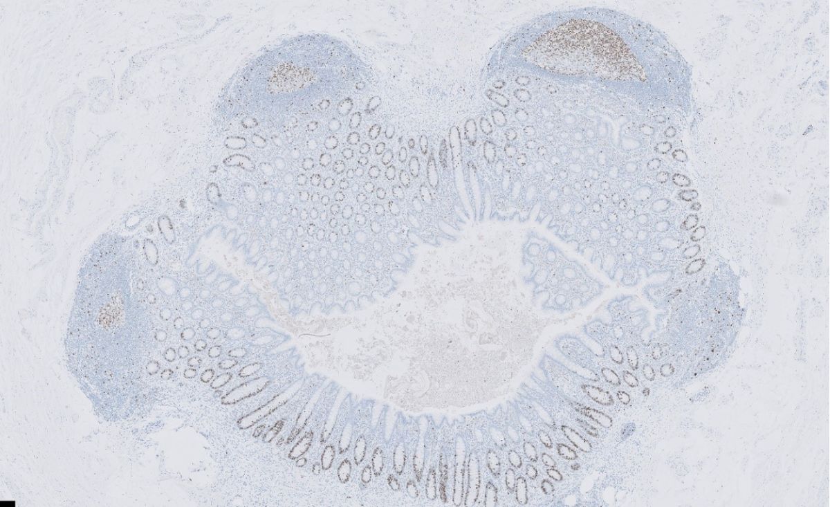 immunologie-1-f6f8d81f image Immunopathologie Foto 1 : Ki-67 kern kleuring, delende cellen in blinde darm.