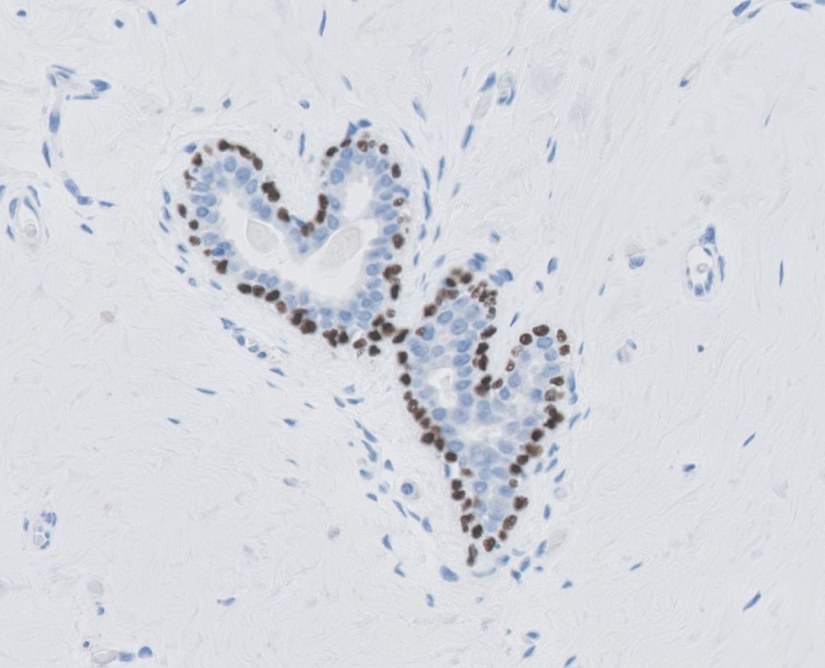 immunologie-2-943037c4 image Immunopathologie Foto 2 : P63 kernkleuring, myo-epitheliale cellen in klierbuizen van mamma(borst)weefsel.